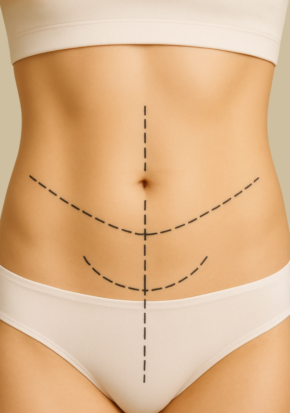 Abdominoplastia em âncora