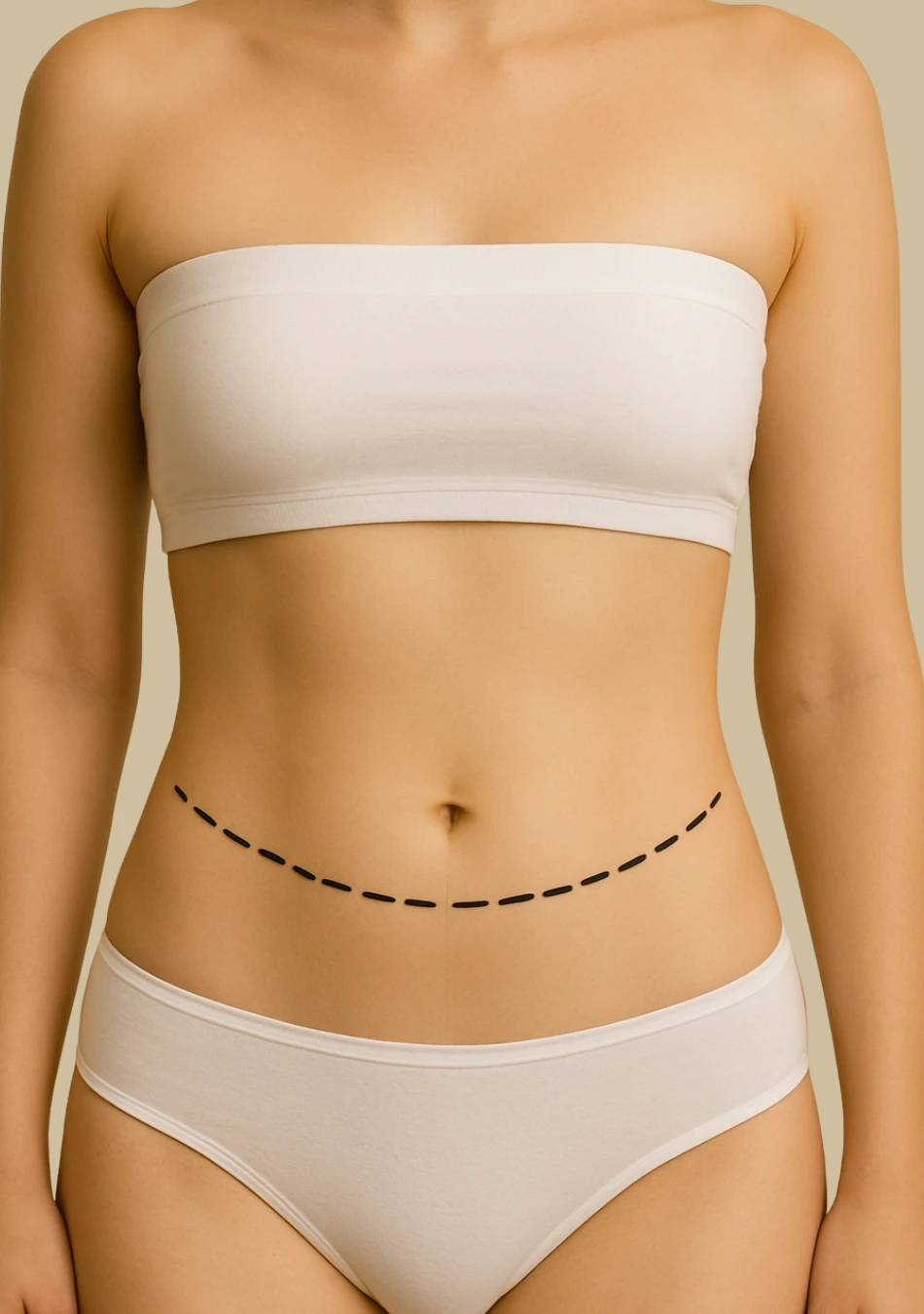 Miniabdominoplastia