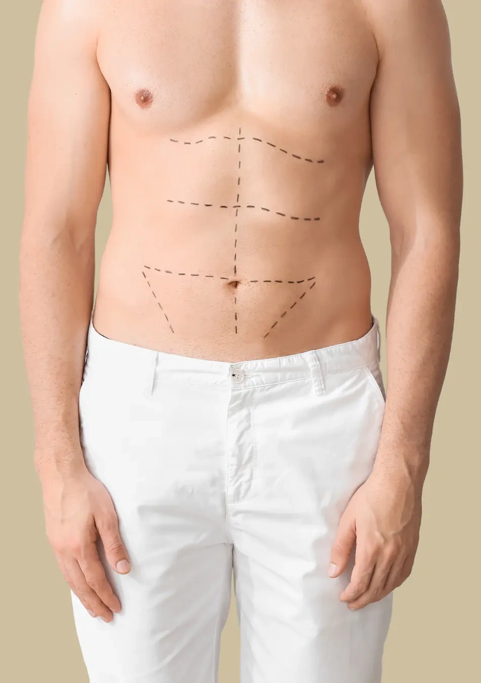 abdominoplastia-2 mulher se olhando no espelho